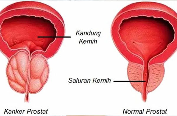 Bercinta dan ejakulasi bisa turunkan risiko kanker prostat